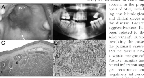 Figure 1. Solid Adenoid Cystic Carcinoma - Figures: A. Clinical findings of palate ACC
