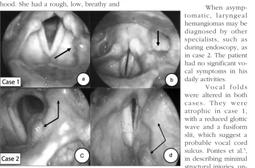 Figure 1. Laryngeal hemangioma (arrows).