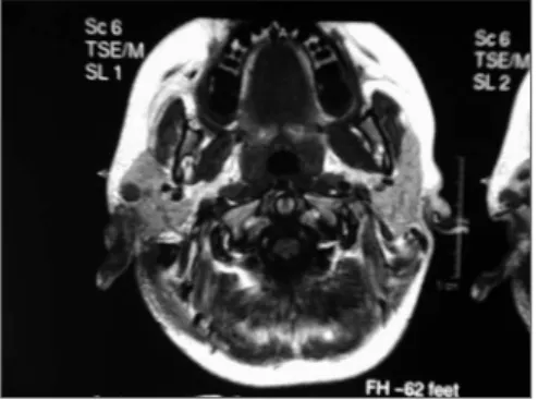Figura  1.  Ressonância  nuclear  magnética  de  crânio  -  pre- pre-sença  de  lesão  em  ambos  os  ossos  temporais  compatível  com histiocitose x.