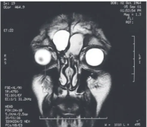 Figura 1. Ressonância Magnética de Seios Paranasais, corte  coronal, T2. Mucocele Frontal Bilateral.