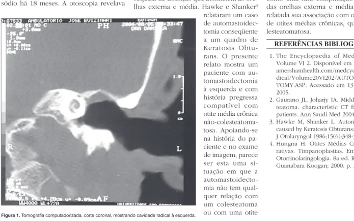 Figura 1. Tomografia computadorizada, corte coronal, mostrando cavidade radical à esquerda.