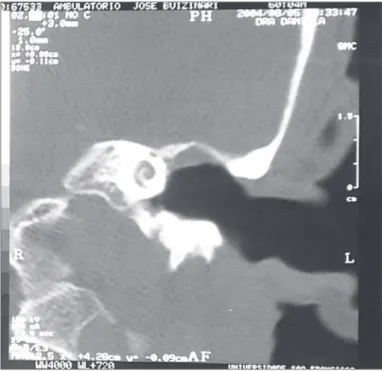 Figure  1.  Computed  tomography,  coronal  section,  showing  radical  mastoidectomy  cavity  to  the left.