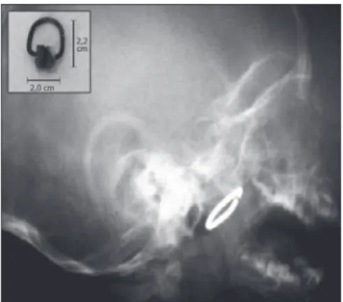 Figura  1.  Em  a,  exame  radiológico  evidenciando  corpo  estranho em nasofaringe. Em b, gancho de trilho de cortina  removido da região da nasofaringe; observar o grau de  oxi-dação das partes metálicas.