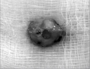 Figure 4. Graft block, periosteum and cortex resection with the os- os-teotome.