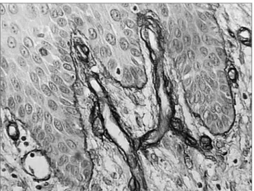 Figure 3. Moderate immunohistochemical expression of laminin in the  basal membrane of an oral squamous cell carcinoma