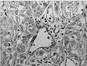 Figure 4. Discrete immunohistochemical expression of laminin. Note  the intense marking of blood vessels in the tumor stroma