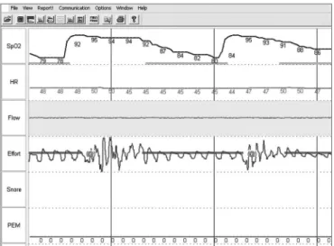 Figure 2. Polysomnography during nasal endoscopy under induced  sleep.