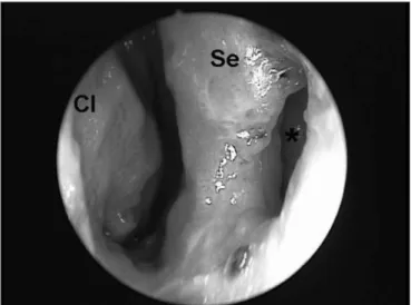 Figure 3. Deformity of the external structure of the nasal pyramid in a  patient with mucosal leishmaniasis.