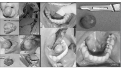 Figura  1.  Lipomas  da  cavidade  oral:  (da  esquerda  para  direita)  Caso  1:  Pré-operatório,  aspecto  trans-operatório,  aspecto  macroscópico  e  aspecto  histológico
