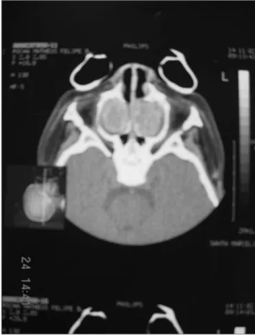 Figure 1. Figures 1 and 2. Paranasal sinuses CT Scan, axial view, soft tissue 