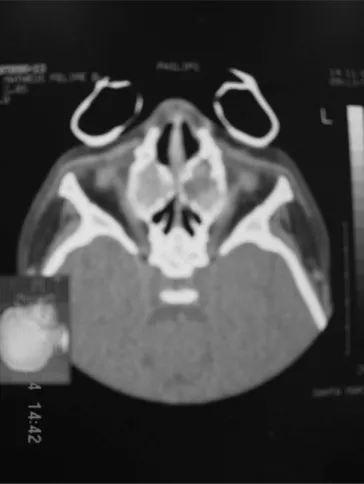 Figure 3. Paranasal sinuses CT Scan, axial view, bone window, sho- sho-wing nasal cavities obstruction caused by a bilateral maxillary cystic  formation and a hypertrophy of pharyngeal tonsils.