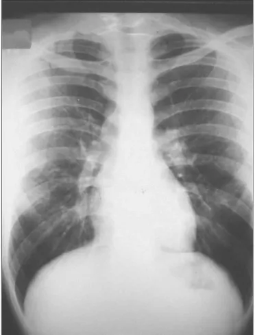 Figure 2. Normal chest x-ray. 