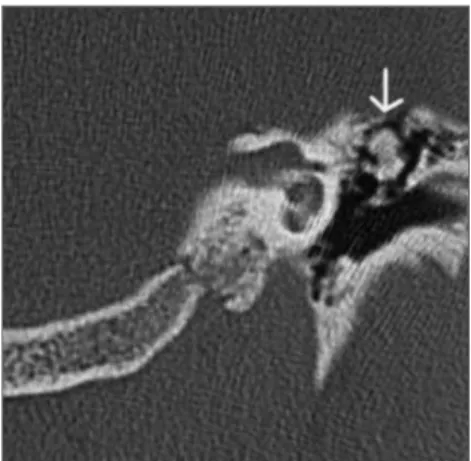 Figura 1.  Tomografia computadorizada da mastóide em  corte coronal evidenciando o osteoma.
