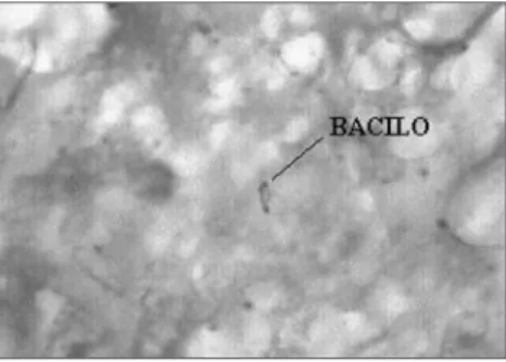 Figure 1. ZIEHL 1000X: Histopathology for BAAR search,  showing microorganisms with structures matching those of  the Koch’s Bacillus.