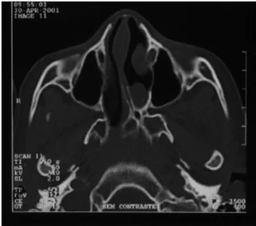 Figure 1. A case of left side choanal atresia and symmetrical maxillary  sinuses and no sinus disease.