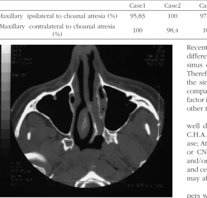 Table 1. Maxillary sinuses size comparison - * Kruskal-Wallis test: Value = 4.846; p = 0.183 ** The largest size maxillary sinus was considered  as 100%