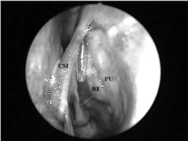 Figure  1.  Left  nasal  cavity  endoscopy  showing  the  flexible  plastic  tube emerging from the middle meatus (CM = middle turbinate; PU 