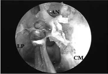 Figure 4B. Ethmoidal bulla superior portion exeresis and consequent  frontal  sinus  ostium  visualization  when  catheterized  by  the  flexible  plastic  tube  (CM  =  middle  turbinate;  BE  =  ethmoidal  bulla;  SF  =  frontal sinus).