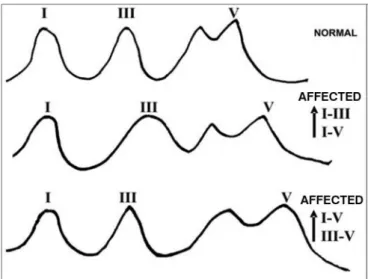 Figure 5. Examples of  BERA traces inter-peak intervals in retroco- retroco-chlear lesions