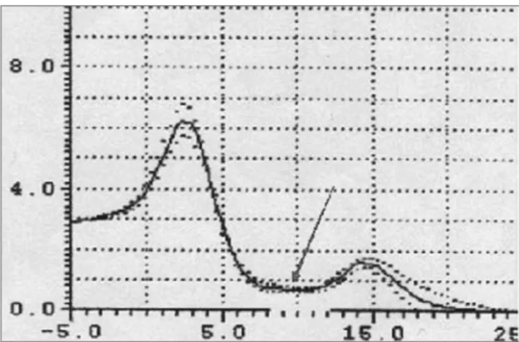 Figure  10  -  Increased  OF  segment  in  patients  with  redundant  soft  palate and uvular hypertrophy.
