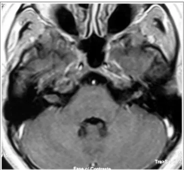 Figure  4.  MRI  (T1  contrast-enhanced)  case  4  preoperative  axial  view.