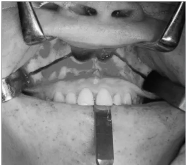 Figure 2. Maxillary Le Fort I osteotomy.