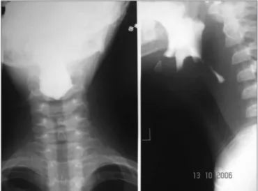 Figure 1. Esophageal stenosis in the cricoid constriction