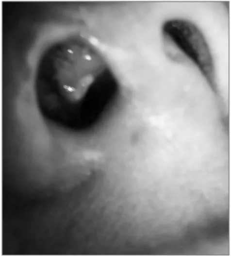 Figure 1. Nostril and nose vestibule with a yellow-grayish  burn surrounded by erythema.