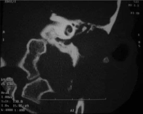 Figure 1. Temporal bone CT Scan - Left Ear.