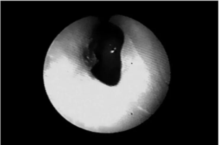 Figure 1. Nasal cavity stenosis