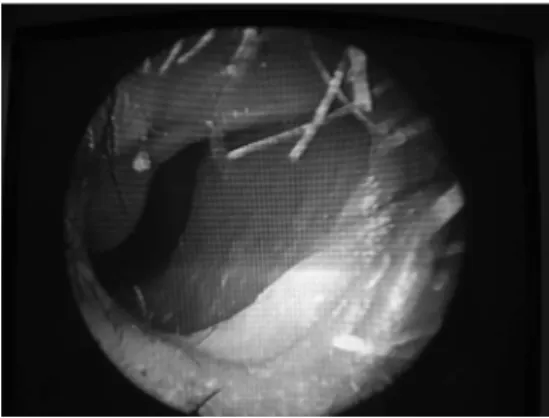 Figure 1. skin-mucosa joint in the nasal cavity: incision site and closure  in two suture planes - Young’s approach.