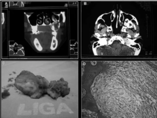 Figure  1.  A-  CT  scan  coronal  section,  B-  CT  scan  axial  section,  C-  Surgical Specimen, D- Histopathology Cross-Section.