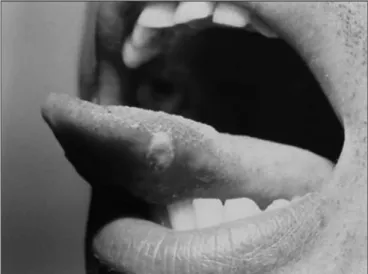 Figure 2. Aphtha major on the lower lip. Notice scar lesions
