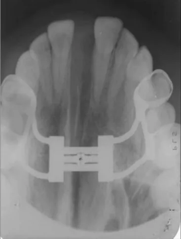 Figure 4.  Occlusal radiograph of the maxilla after the maxillary expan- expan-sion procedure