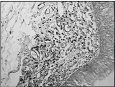Figure 1 - Immunohistochemistry for B lymphocytes in vestibular folds  - AIDS-free patients with peritonitis as the cause of death (PAP X200)