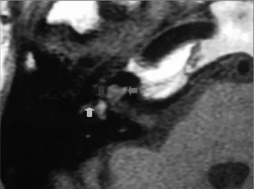 Figure 2. Pure tone audiometry after drug therapy.