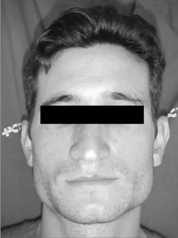 Figure 1. Patient with bilateral masseter muscle hypertrophy.