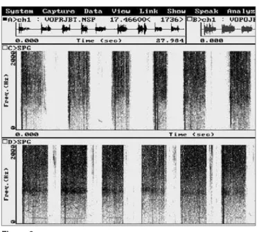 Table 2. Mean phonation time values, in seconds, before (PRE) and  after (POST) application of 100 units of the botulinum toxin in the  pharyngoesophageal segment.