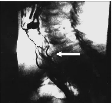 Figure 4. Videofluoroscopy - lateral view - during phonation before (a)  and after (b) injection of the botulinum toxin in the pharyngoesophageal  segment