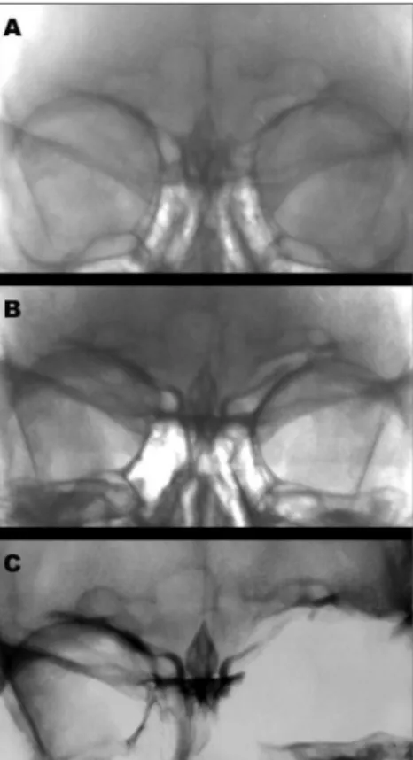 Figure  1.  Images  of  the  victim’s  frontal  sinus  in  1989(A),  1993(B), and post-mortem in 2006(C).