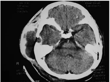 Figure 3. Mastoid CT scan, with a cystic soft tissue mass on the right  temporal region, with peripheral contrast uptake, temporal lytic lesion  on the right side with contrast uptake by the underlying dura matter.