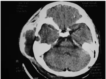 Figure 3. Mastoid CT scan, with a cystic soft tissue mass on the right  temporal region, with peripheral contrast uptake, temporal lytic lesion  on the right side with contrast uptake by the underlying dura matter.