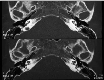Figure 1. Normal bilateral vestibular aqueduct - Temporal bone CT  scan - axial view.