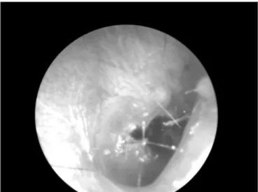 Figure 2. External auditory canal skin laceration.