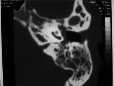 Figure 1. Case 2. Computed tomography showing treatment-resistant  otomastoidits. Plain mastoidectomy was recommended.