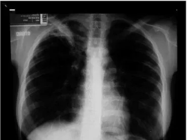 Figure 2. Case 2. Asymptomatic pulmonary involvement in the right  apex and the left base of the lung.