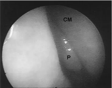 Figure 1. Endoscopic image of a grade III polyp in the right nasal cavity  of patient #1