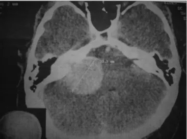 Figure  1. Mastoid CT scan showing a globus lesion (33.3mm in its  largest axis), extending to the internal auditory meatus and enlarging  it
