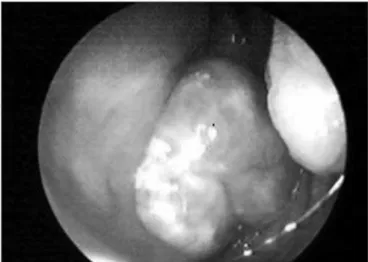 Figure 1. Endoscopic image of a tumor in the cavum.