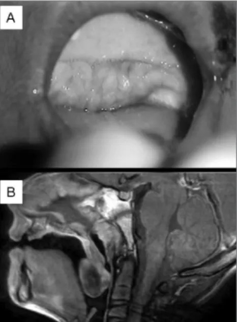 Figura  1A  e  B.  Tumor  ocupando  palato  mole  e  pilares  amigdalianos.